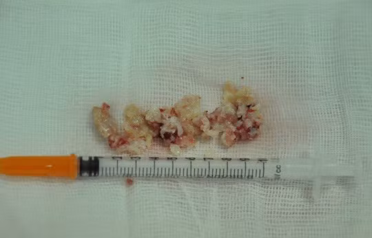 Hàng trăm khối silicon vón cục được gắp ra từ mũi bệnh nhân. Hàng trăm khối silicon vón cục được gắp ra từ mũi bệnh nhân.