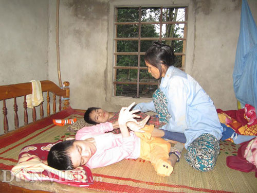 Vợ chồng ông Nguyễn Văn Bồng và bà Trần Thị Gái (trú thôn Tân Hiệp, xã Cam Tuyền) sinh được 8 người con thì 6 người bị dị tật. Trong đó, Nguyễn Thị Tài (30 tuổi) và Nguyễn Thị Tuyết (23 tuổi, trong ảnh) bị nặng nhất, bại não, nằm liệt giường quằn quại, la hét suốt ngày đêm. Dù đã chạy chữa khắp nơi, kiệt quệ gia tài nhưng Tài và Tuyết vẫn không thể phục hồi.