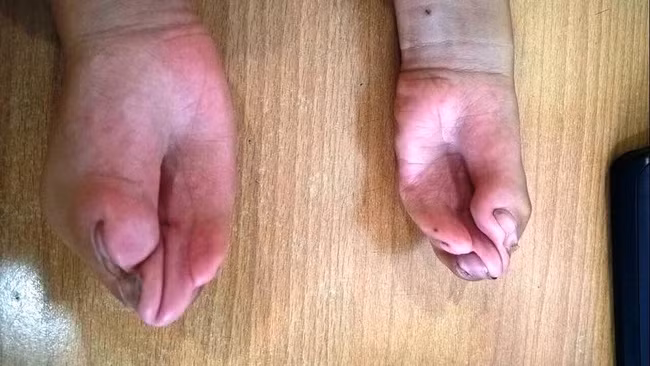 Nghi luc phi thuong cua co be khong co ngon tay-Hinh-2