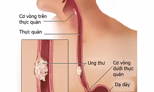 Dau hieu de thay cua ung thu thuc quan
