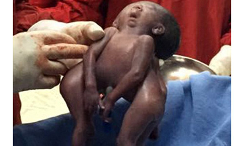 Cặp song sinh chung đầu mới chào đời ở Ấn Độ.