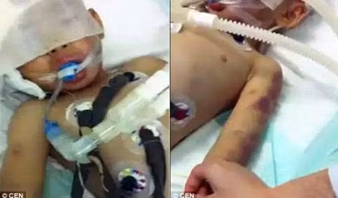 Những vết thâm tím trên cơ thể cậu bé Pu.