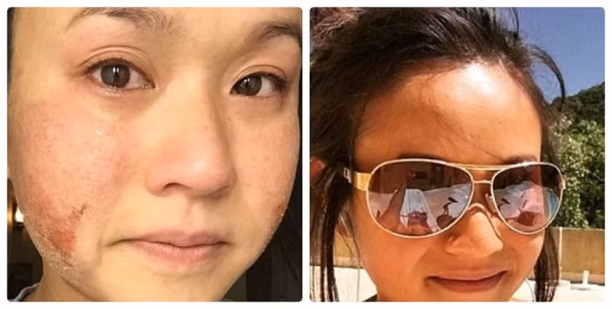 Những vết loét dị ứng sau khi nâng ngực ngày càng lan rộng và còn bị bong tróc mỗi khi cô di chuyển hay làm việc gì.