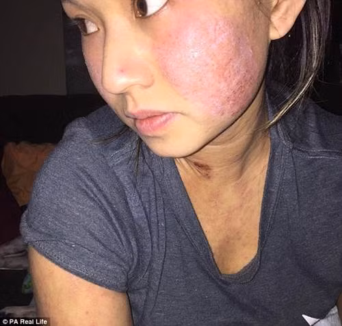 Sau khi phẫu thuật nâng ngực, cô bị dị ứng, trên da xuất hiện các mảng sần sùi, lở loét.