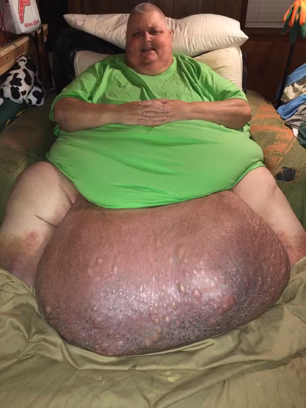 Chi vi 1 soi long moc nguoc, mang khoi u 63 kg