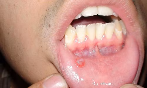 U la xuat hien trong mieng, vo chong chui nhau tanh banh