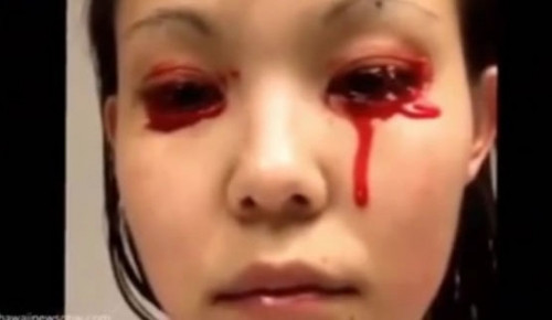 Hội chứng khóc ra máu tưởng như chỉ có trong các bộ phim kinh dị nhưng thực chất nó là một triệu chứng của viêm kết mạc cấp và xung huyết cấp.