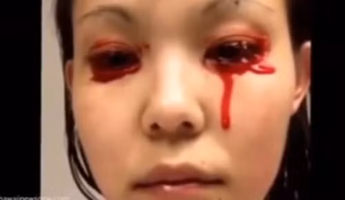 Hội chứng khóc ra máu tưởng như chỉ có trong các bộ phim kinh dị nhưng thực chất nó là một triệu chứng của viêm kết mạc cấp và xung huyết cấp.