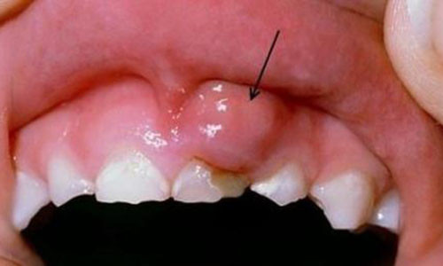 Ung thư miệng là loại ung thư phổ biến thứ 6 trên thế giới.