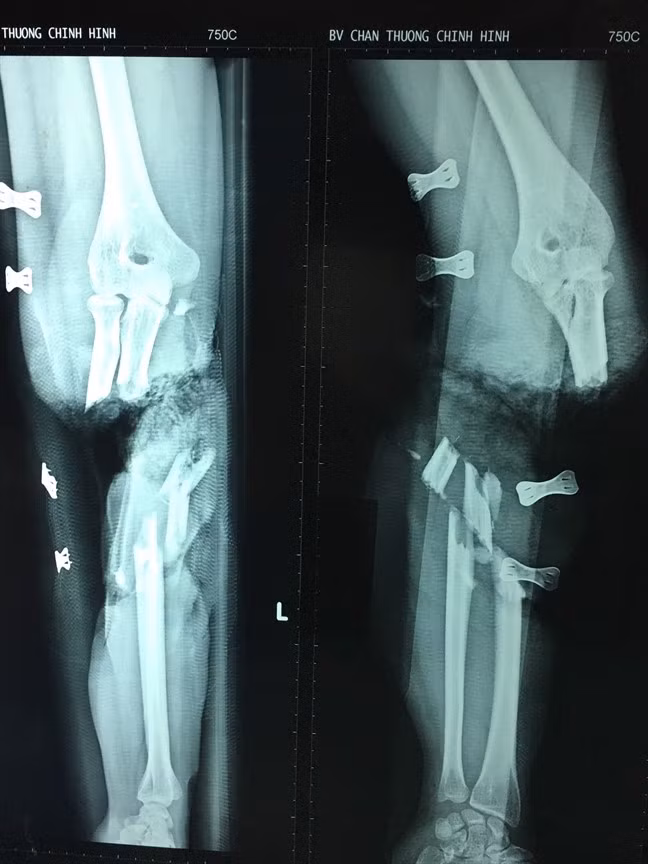 Co gai 21 tuoi hoi sinh canh tay ky dieu