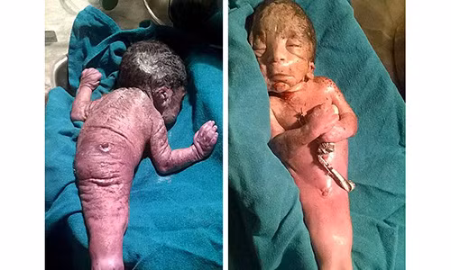 Sốc: “Người cá” vừa được sinh ra tại Ấn Độ Soc: “Nguoi ca” vua duoc sinh ra tai An Do