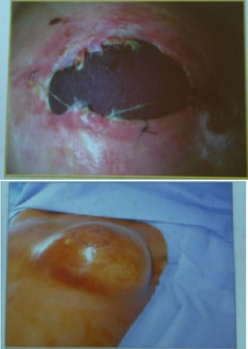 Ngực bị toác vết mổ lộ túi ngực và bị nhiễm trùng. Ảnh: Bác sĩ cung cấp