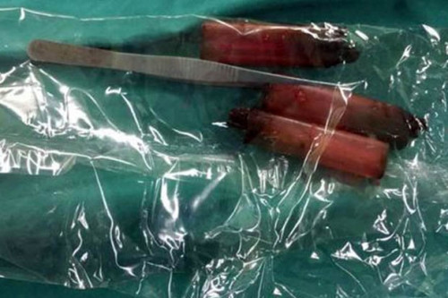 Chiếc bật lửa và chiếc nhíp các bác sĩ lấy ra từ dạ dày ông Hua.