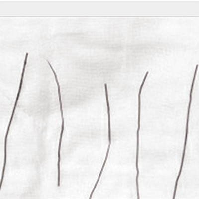 Anh A Biao đã nuốt những chiếc ghim này vào bụng.