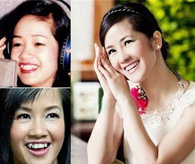 Tuy nhiên, cô đã nhổ bỏ chúng để có hàm răng đều.