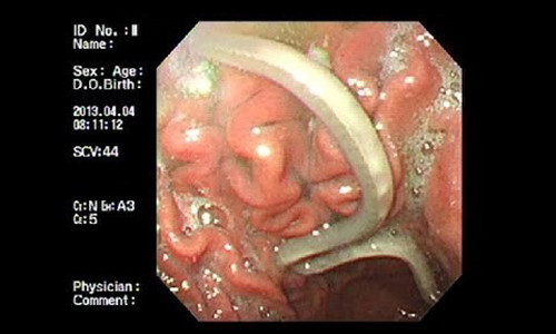 Ron nguoi con vat ki sinh trong da day nguoi Viet