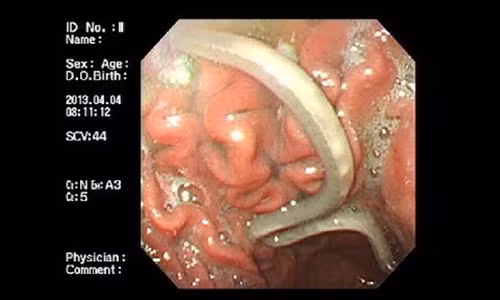 Ron nguoi con vat ki sinh trong da day nguoi Viet