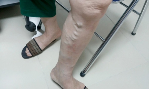 Hang trieu nguoi Viet mac benh o chan ma khong biet