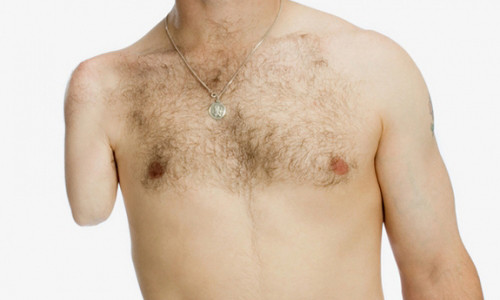 Một bệnh nhân mắc BIID đã tự cắt tay mình.