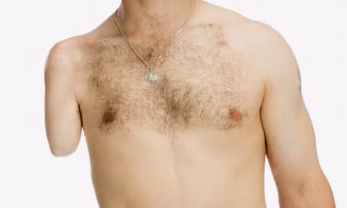 Một bệnh nhân mắc BIID đã tự cắt tay mình.