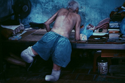 Ông Nguyễn Xuân Phước (83 tuổi) bị cụt cả hai chân. Ông kể: “Trước đây, khi chưa có đôi chân giả, mỗi lần đi lại tôi phải dùng hai tay lết từ chỗ này qua chỗ khác, có lúc ngã dúi đầu về phía trước, giập trán đổ máu”.