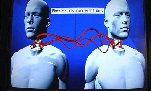 Cấy ghép đầu đang là tham vọng lớn nhất hiện nay của các bác sĩ Trung Quốc.