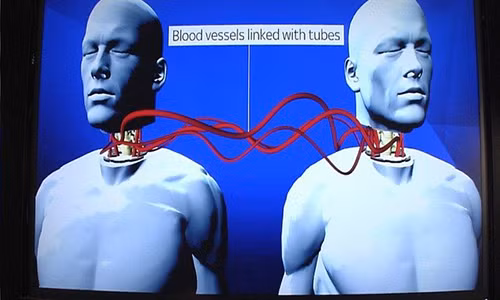 Cấy ghép đầu đang là tham vọng lớn nhất hiện nay của các bác sĩ Trung Quốc.