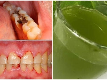 Sau rang bien mat chi can loai nuoc suc mieng nay