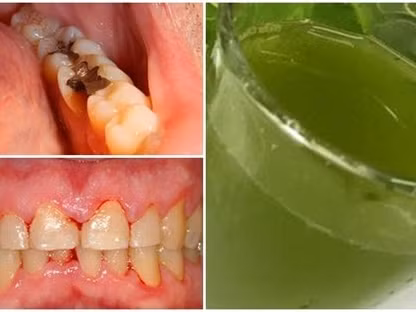 Sau rang bien mat chi can loai nuoc suc mieng nay