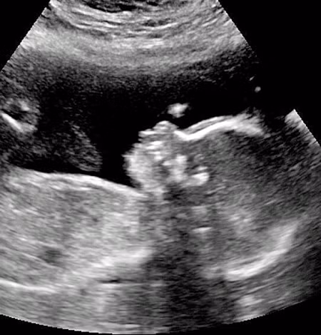 Cậu được phát hiện có nhiều tóc từ khi trong bụng mẹ.