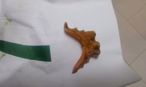 Nuốt phải hàm răng giả, tưởng thường thôi ai dè thủng ruột Nuot phai ham rang gia, tuong thuong thoi ai de thung ruot