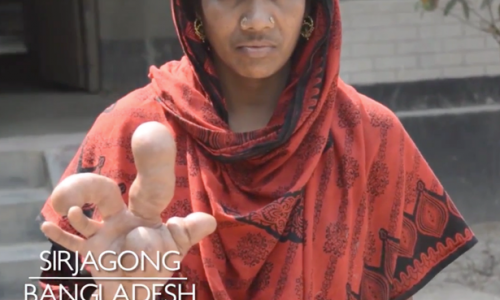 Cô Afroza Begum và ngón tay lạ.