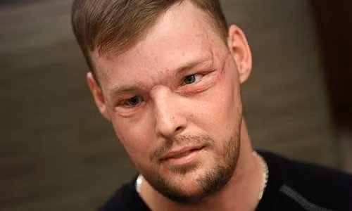 Phau thuat thanh cong ca ghep mat hiem gap tren the gioi