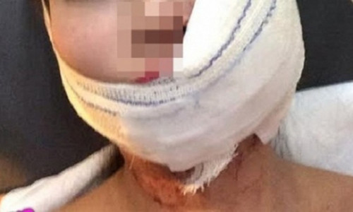 Ghen tuông bà chủ đã rạch mặt nữ nhân viên. (hình minh họa)