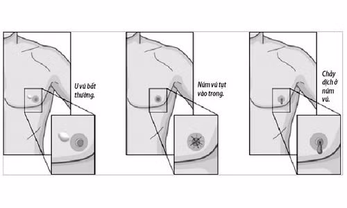 Cac dau hieu bao dong ung thu vu o nam gioi