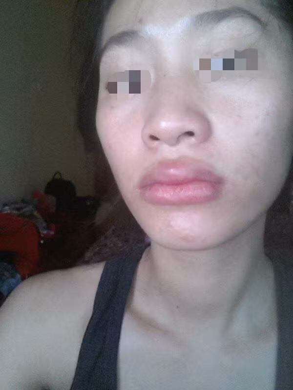 Kinh hai hau qua cua don cam, nang mui khong phau thuat-Hinh-3