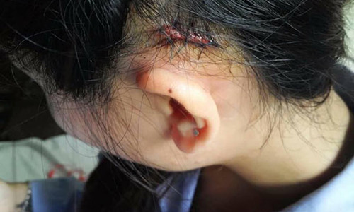 Tam su cua me don than ket hon nam 15 tuoi, bi chong danh rach da dau