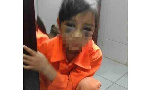 Hình ảnh bé T. bị tím 2 mắt lan truyền trên mạng xã hội. Ảnh: Facebook