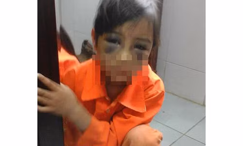 Hình ảnh bé T. bị tím 2 mắt lan truyền trên mạng xã hội. Ảnh: Facebook