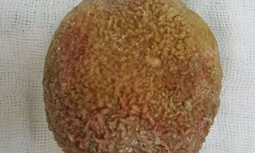 Benh nhan 65 tuoi soc voi vien soi bang quang khong lo