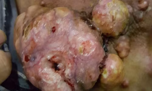 Khối u di căn của ung thư thanh quản.