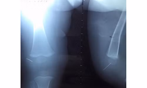 Phim chụp ½ kim khâu dài 3cm mắc kẹt trong khớp gối của cháu Toàn.