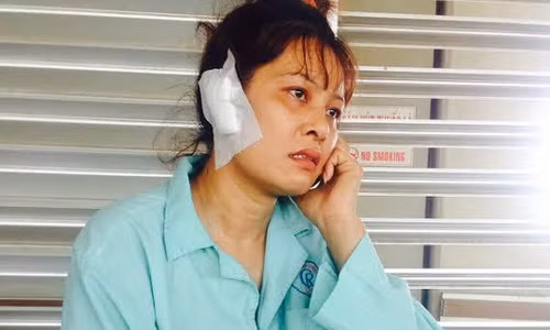 Chị Xuân bị chồng cắn rớt tai phải.