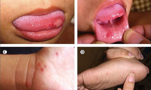 Các biểu hiện của bệnh tay chân miệng ở trẻ. Ảnh: Markmedicalsupplies.