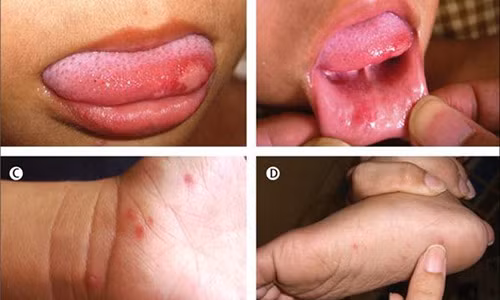 Các biểu hiện của bệnh tay chân miệng ở trẻ. Ảnh: Markmedicalsupplies. Các biểu hiện của bệnh tay chân miệng ở trẻ. Ảnh: Markmedicalsupplies.