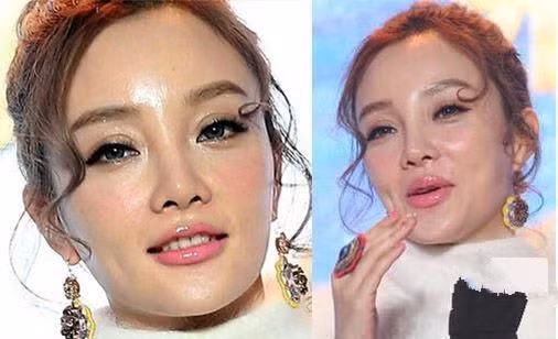Mới đây, Lý Tiểu Lộ ngày lộ rõ gương mặt thô cứng vì phẫu thuật thẩm mỹ. Đặc biệt gò má, cằm, mũi và trán đều bắt đầu “tố cáo” bà mẹ hai con từng trải qua phẫu thuật thẩm mỹ.
