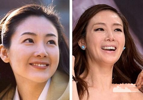 Vẻ đẹp thuần khiết và trong sáng một thời của Choi Ji-woo từng khiến bao khán giả mê mẩn, xuýt xoa. Còn ở thời điểm hiện tại, ngay đến nụ cười của ngôi sao Bản tình ca mùa đông cũng lộ rõ sự thiếu tự nhiên, có phần kì dị vì nụ cười khá khó nhọc do các cơ quanh miệng đã trải qua dao kéo. Nhiều người khẳng định gương mặt của nữ diễn viên 41 tuổi giờ đây như “mặt nạ” vì phẫu thuật thẩm mỹ.