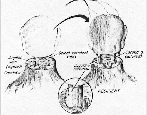 Lanh gay ca ghep dau nguoi vao than the nguoi khac