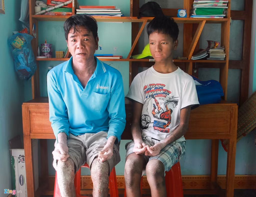 Nhiều người dân ở thôn An Lương (xã Tam Anh Bắc, huyện Núi Thành, tỉnh Quảng Nam) gọi cha con Vương bằng cái tên chua xót: “Người rắn”. Lý do là ông Nguyễn Đình Nhi (bố của Vương) mang căn bệnh giống vảy nến, sau đó di truyền cho con trai.