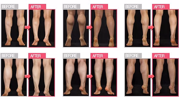 Những biến chứng có thể xảy ra khi thực hiện phương pháp này là việc tụ máu tại vết mổ, hoặc bị nhiễm trùng máu nếu quá trình khử trùng không được kỹ càng. Bên cạnh đó, hình dạng chân của bệnh nhân cũng có thể biến dạng, trở nên bất đối xứng. Ngoài ra, bệnh nhân còn phải chấp nhận việc đi lại khó khăn trong vòng hai tuần đầu sau phẫu thuật.